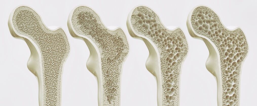 a csípőízület deformáló artrózisának kezdeti stádiuma